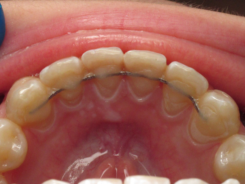 L'importance de la contention en orthodontie