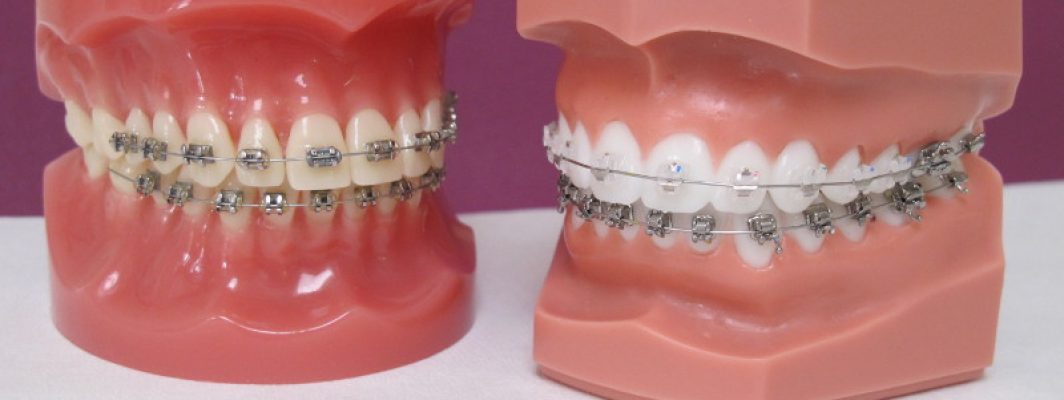 appareil d'orthodontie fixe